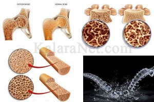 L'ostéoroporose est une maladie qui fragilise les os – KalaraNet.com – Août 2016